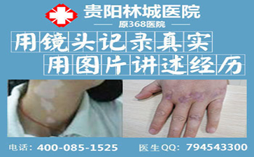 为什么要治疗白癜风